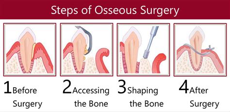 osseous surgery cost